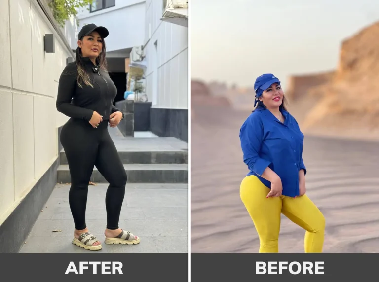 Stomach-Botox-111