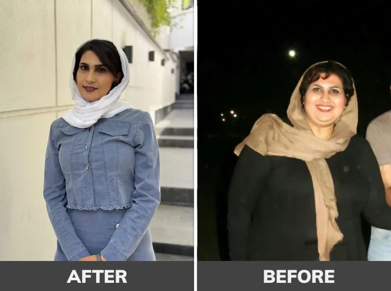 Stomach-Botox-222