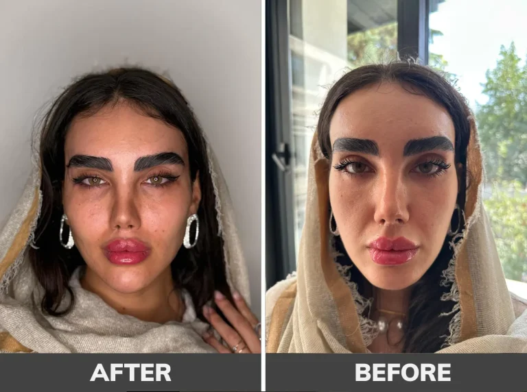 gel-contouring-2