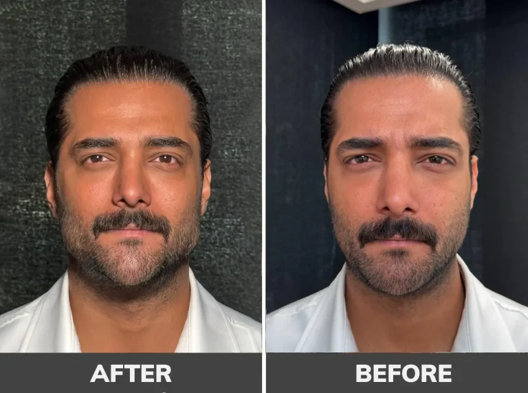 gel-contouring-5