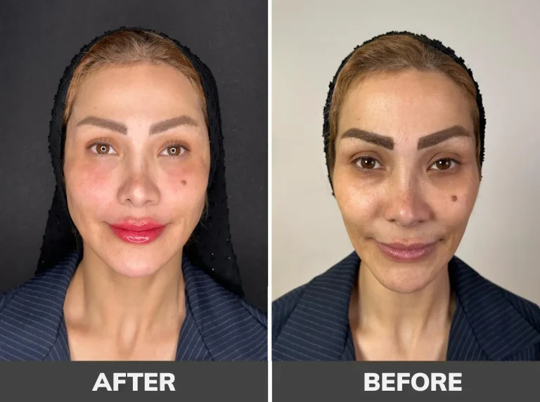 gel-contouring-6
