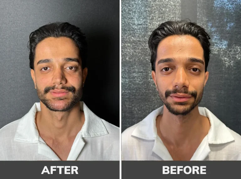 gel-contouring-7