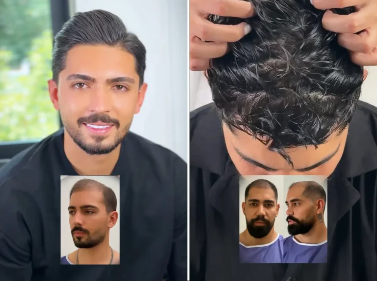 hair-transplant-1